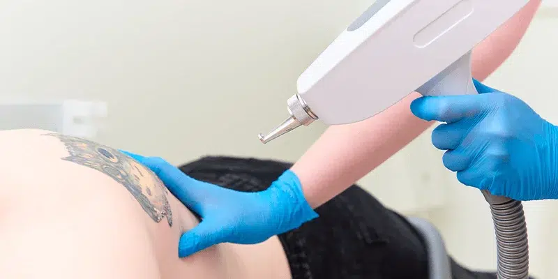 how-to-stand-out-from-other-laser-tattoo-removal-device-providers